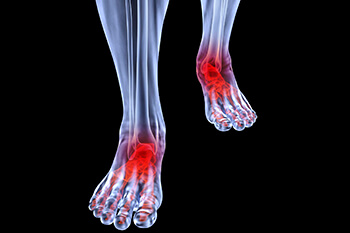 Arthritic foot and ankle care treatment, foot arthritis treatment in the Dallas County, TX: Dallas (Garland, Richardson, Addison, Zacha Junction, Highland Park, University Park, Rowlett, Coppell); Tarrant County, TX: Arlington, Euless, Bedford, Hurst, Colleyville; Collin County, TX: Carrollton (Plano, Frisco), and Denton County, TX: Lewisville, The Colony, Hackberry, Little Elm, Highland Village areas