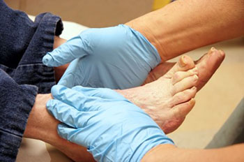 Diabetic foot treatment and care, Diabetic Ulcers Treatment & Management in the Dallas County, TX: Dallas (Garland, Richardson, Addison, Zacha Junction, Highland Park, University Park, Rowlett, Coppell) and Irving (Grand Prairie, Cockrell Hill); Tarrant County, TX: Arlington, Euless, Bedford, Hurst, Colleyville; Collin County, TX: Carrollton (Plano, Frisco), and Denton County, TX: Lewisville, The Colony, Hackberry, Little Elm, Highland Village areas