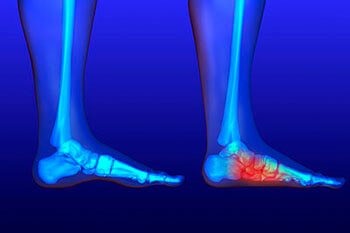 Flat feet and Fallen Arches treatment, Flatfoot Deformity Treatment in the Dallas County, TX: Dallas (Garland, Richardson, Addison, Zacha Junction, Highland Park, University Park, Rowlett, Coppell); Tarrant County, TX: Arlington, Euless, Bedford, Hurst, Colleyville; Collin County, TX: Carrollton (Plano, Frisco), and Denton County, TX: Lewisville, The Colony, Hackberry, Little Elm, Highland Village areas