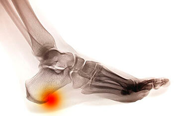 Heel spurs diagnosis and treatment in the Dallas County, TX: Dallas (Garland, Richardson, Addison, Zacha Junction, Highland Park, University Park, Rowlett, Coppell); Tarrant County, TX: Arlington, Euless, Bedford, Hurst, Colleyville; Collin County, TX: Carrollton (Plano, Frisco), and Denton County, TX: Lewisville, The Colony, Hackberry, Little Elm, Highland Village areas