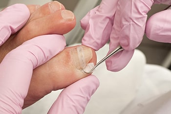 Ingrown toenails diagnosis and management in the Dallas County, TX: Dallas (Garland, Richardson, Addison, Zacha Junction, Highland Park, University Park, Rowlett, Coppell); Tarrant County, TX: Arlington, Euless, Bedford, Hurst, Colleyville; Collin County, TX: Carrollton (Plano, Frisco), and Denton County, TX: Lewisville, The Colony, Hackberry, Little Elm, Highland Village areas
