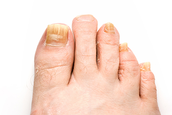 Fungal toenails and podiatric skin conditions diagnosis and treatment in the Dallas County, TX: Dallas (Garland, Richardson, Addison, Zacha Junction, Highland Park, University Park, Rowlett, Coppell); Tarrant County, TX: Arlington, Euless, Bedford, Hurst, Colleyville; Collin County, TX: Carrollton (Plano, Frisco), and Denton County, TX: Lewisville, The Colony, Hackberry, Little Elm, Highland Village areas