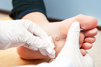 Plantar warts treatment in the Dallas County, TX: Dallas (Garland, Richardson, Addison, Zacha Junction, Highland Park, University Park, Rowlett, Coppell); Tarrant County, TX: Arlington, Euless, Bedford, Hurst, Colleyville; Collin County, TX: Carrollton (Plano, Frisco), and Denton County, TX: Lewisville, The Colony, Hackberry, Little Elm, Highland Village areas