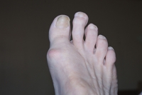 Factors That Cause Numbness in the Toes